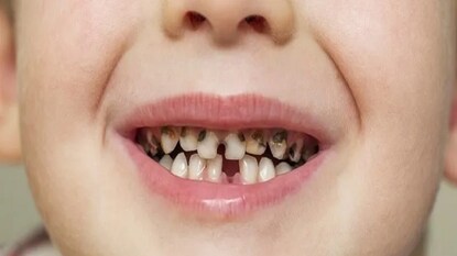 সন্তানের দাঁতে পোকা? সন্তানের দাঁতে পোকা?