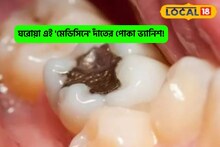 দাঁতের গর্তে 'পোকা'!ডেনটিস্টের কাজ করবে 'এই' ধন্বন্তরি মহৌষধি,ছুমন্তর সব সমস্যা