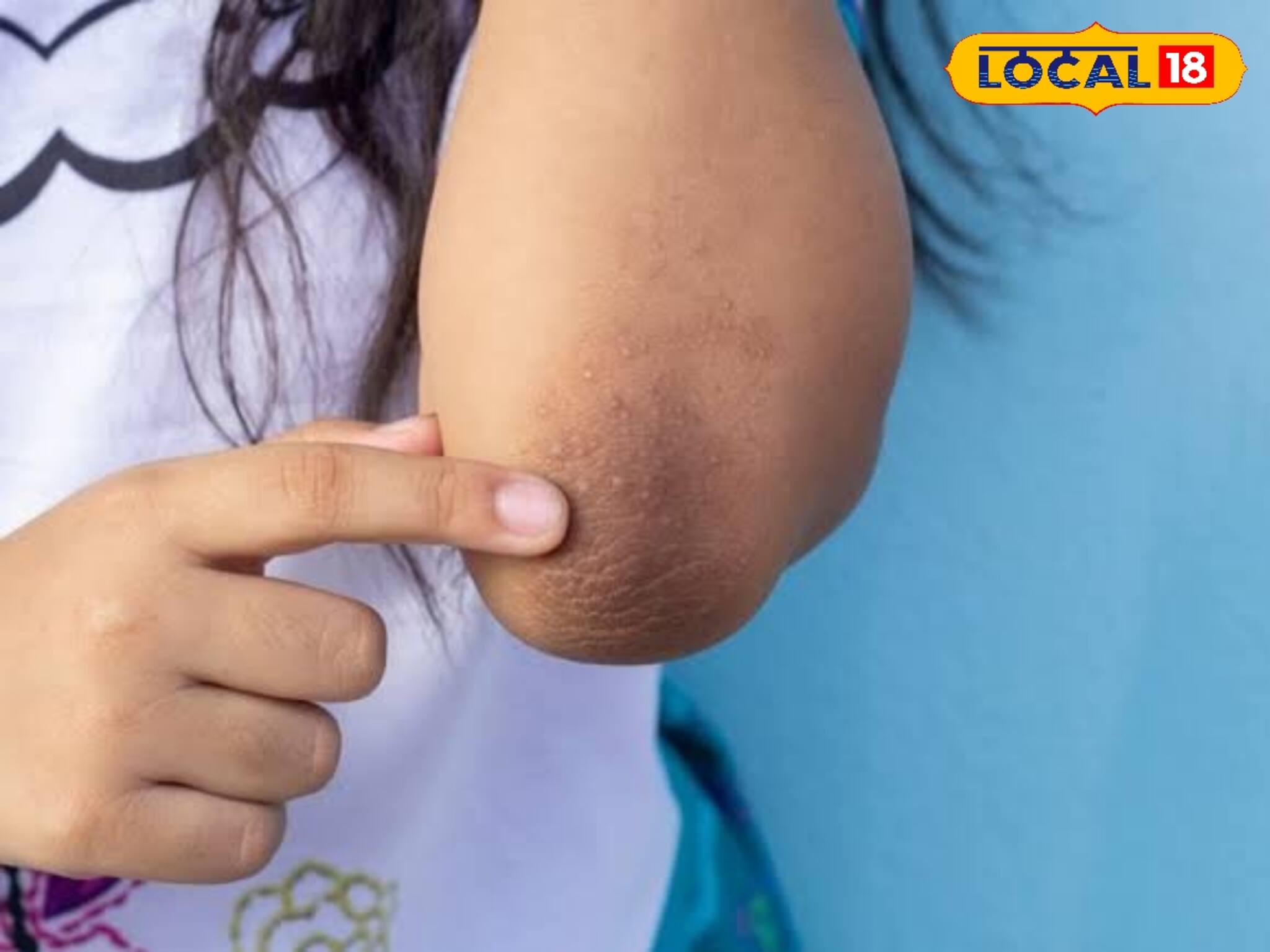 হাঁটু-কনুইয়ে কালো দাগ? ছুটতে হবে না পার্লারে, ঘরোয়া টোটকাতেই হতে পারে সুরাহা