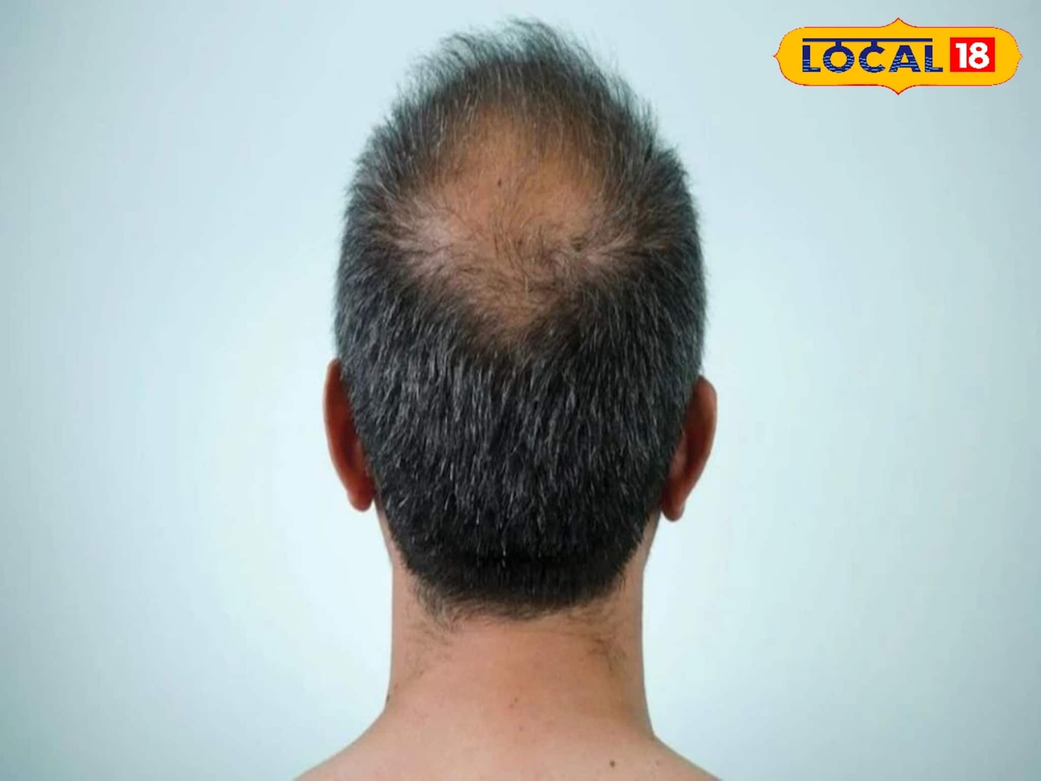 চুল উঠে মাথা গড়ের মাঠ? ঘরোয়া টোটকাতেই লুকিয়ে সমাধান! কয়েক দিনেই টাকে গজাবে চুল!