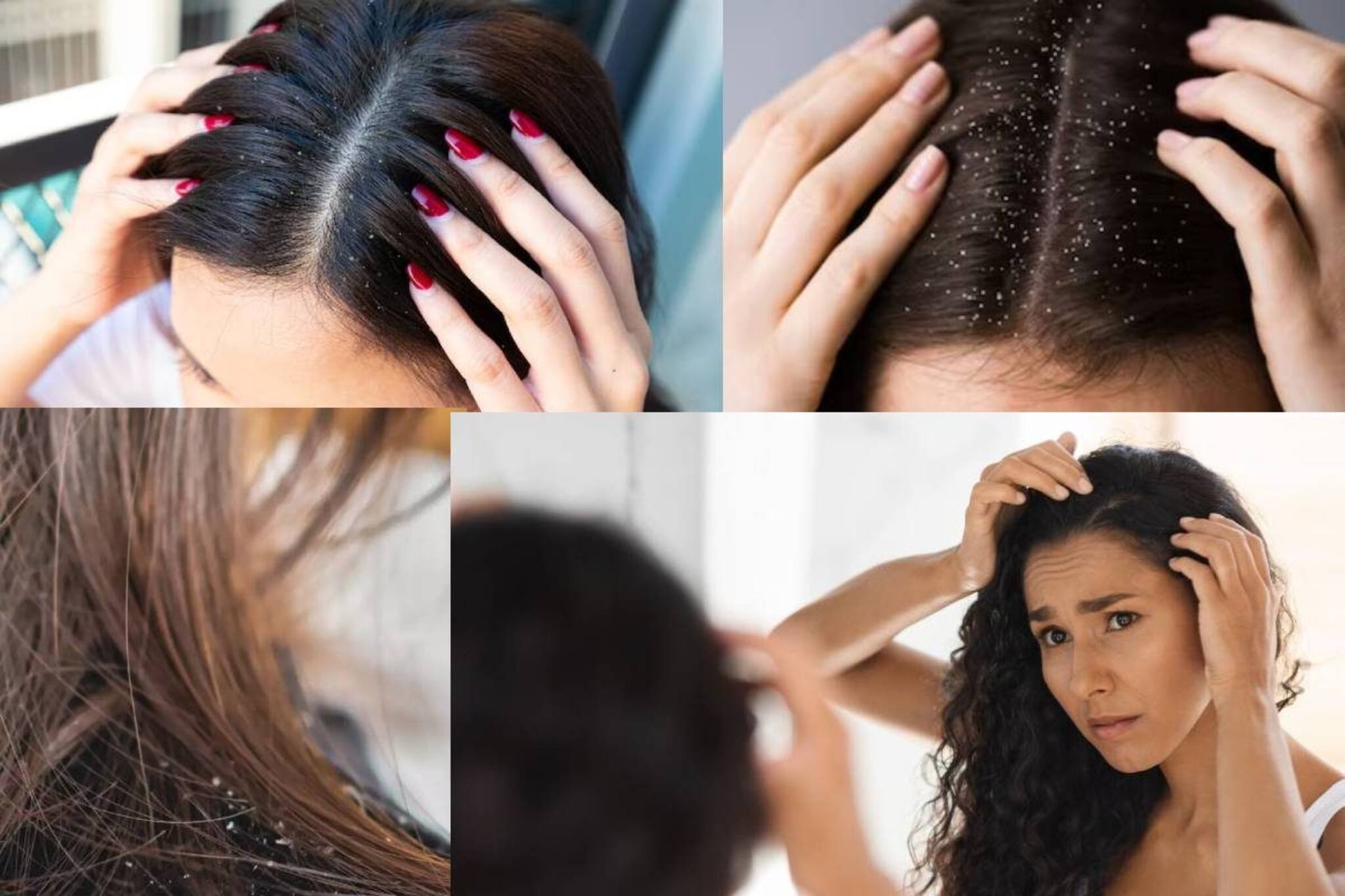 কোন ভিটামিনের অভাবে শীতে খুশকি হয় চুলে? কী খেলে বাড়বে না খুশকি? জানুন