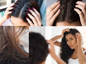 কোন ভিটামিনের অভাবে শীতে খুশকি হয় চুলে? কী খেলে বাড়বে না খুশকি? জানুন