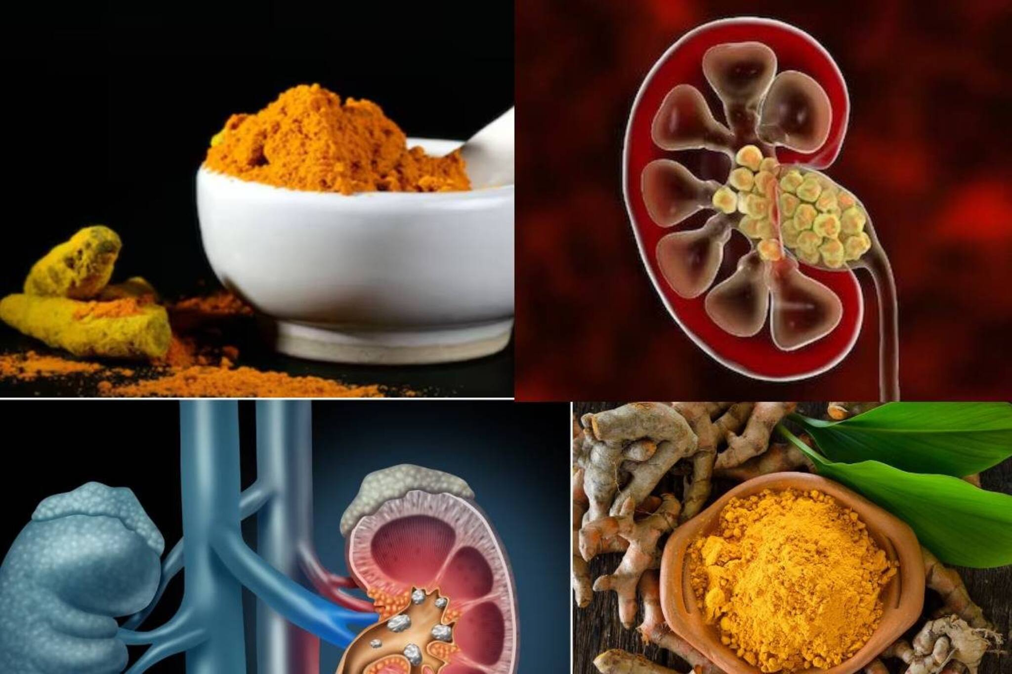 বেশি হলুদ খেলেই কিডনি স্টোন, অ্যানিমিয়ার ভয়? জানুন এই মশলায় আর কী কী হয়