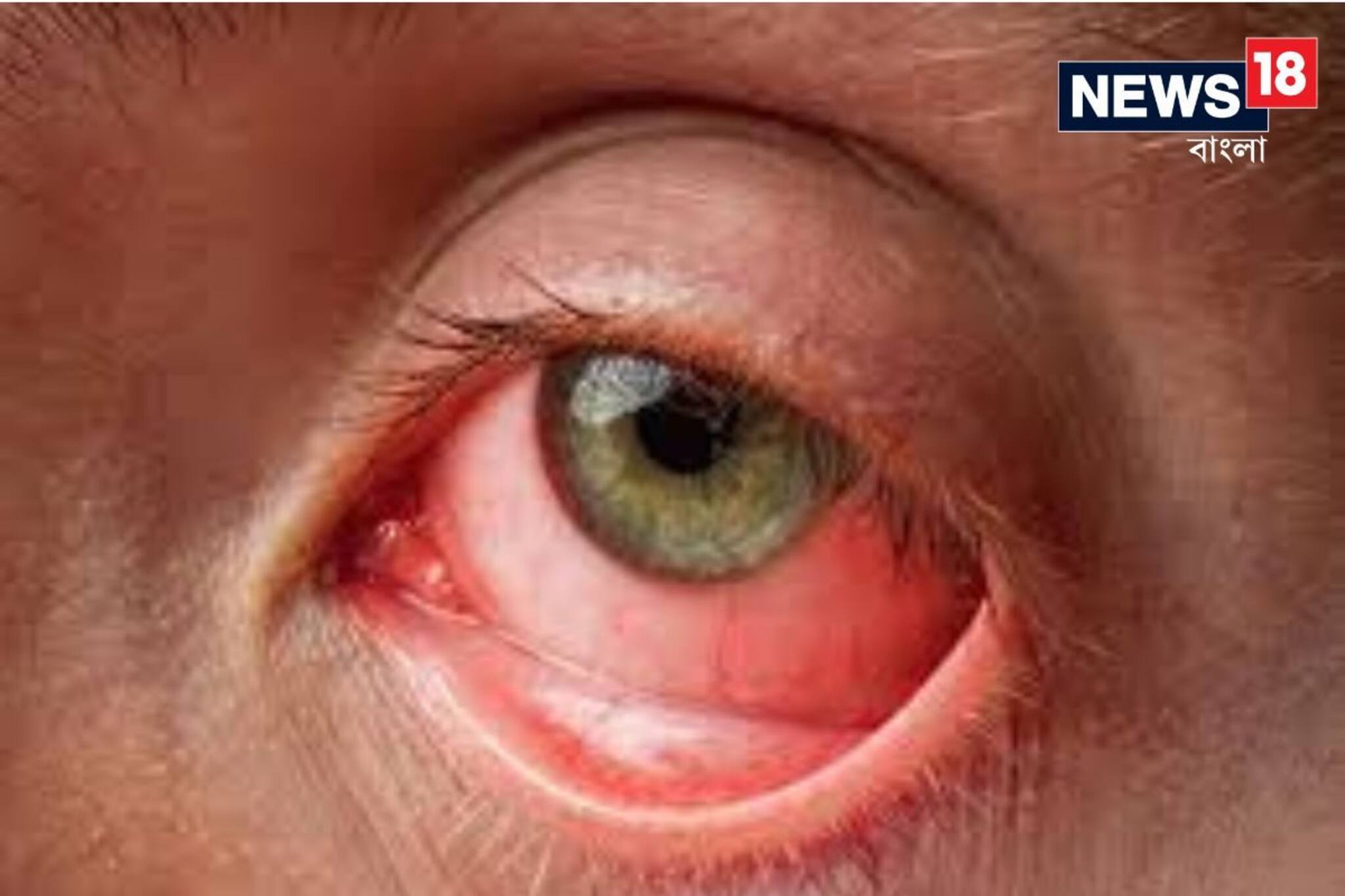 এই ভাইরাসের সংক্রমণে চোখ থেকে গলগল করে রক্ত ঝরে! এখনও পর্যন্ত ১৫ জনের মৃত্যু