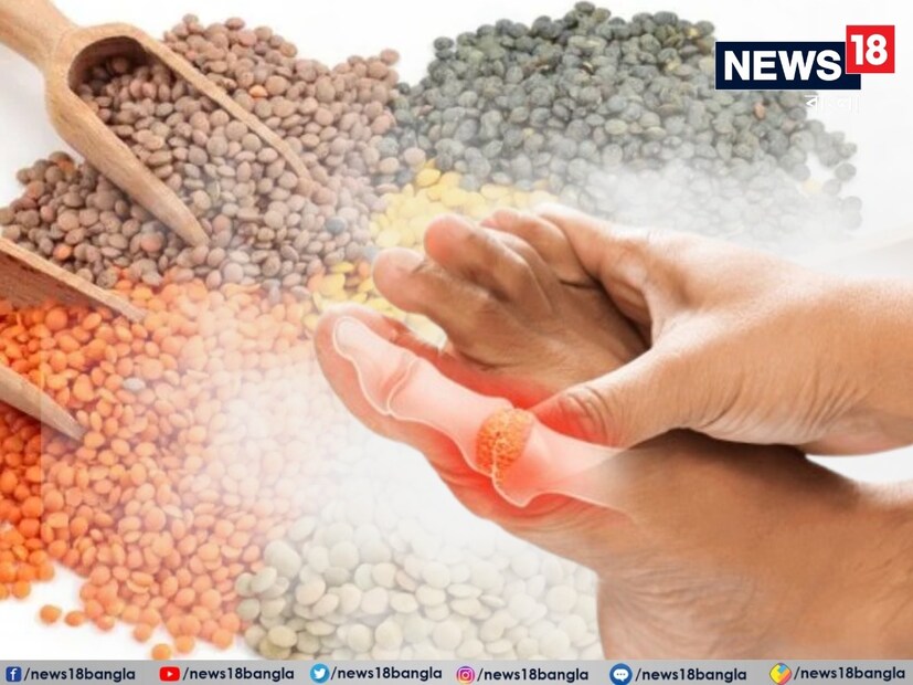 *ইউরিক অ্যাসিডের জন্য কোন ডাল সবচেয়ে ভাল: হাই ইউরিক অ্যাসিডের সমস্যা বেশ সাধারণ। আপনি যদি ইউরিক অ্যাসিডের সমস্যায় ভুগে থাকেন তবে কিছু ডাল খাওয়া এড়িয়ে চলুন। একই সময়ে, কিছু ডাল আপনার জন্য স্বাস্থ্যকরও বটে। মসুর ডাল প্রোটিন এবং ফাইবারের একটি খুব ভাল উৎস, যা উচ্চ ইউরিক অ্যাসিডের মাত্রার সঙ্গে লড়াই করা লোকদের জন্য ঠিক। তবে কিছু ডাল ইউরিক অ্যাসিড রোগীদের জন্য নিষিদ্ধ। সেই সঙ্গে এমন কিছু ডাল রয়েছে যা হাই ইউরিক অ্যাসিডের রোগীদের জন্য উপকারী। সংগৃহীত ছবি। 