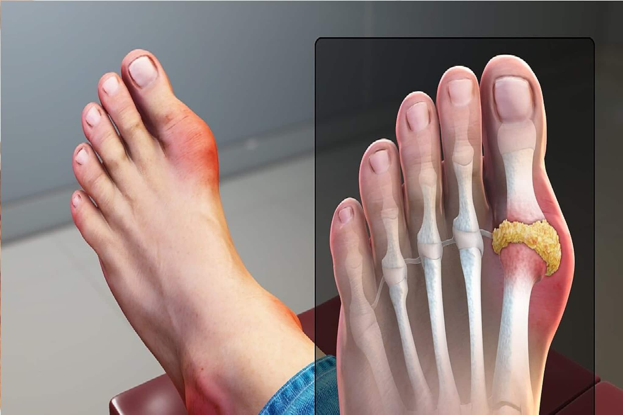 ইউরিক অ্যাসিড থাকলে খাওয়া ভুলে যান, ছোঁবেনও না এই সব্জি! যন্ত্রণায় কাঁপবে শরীর