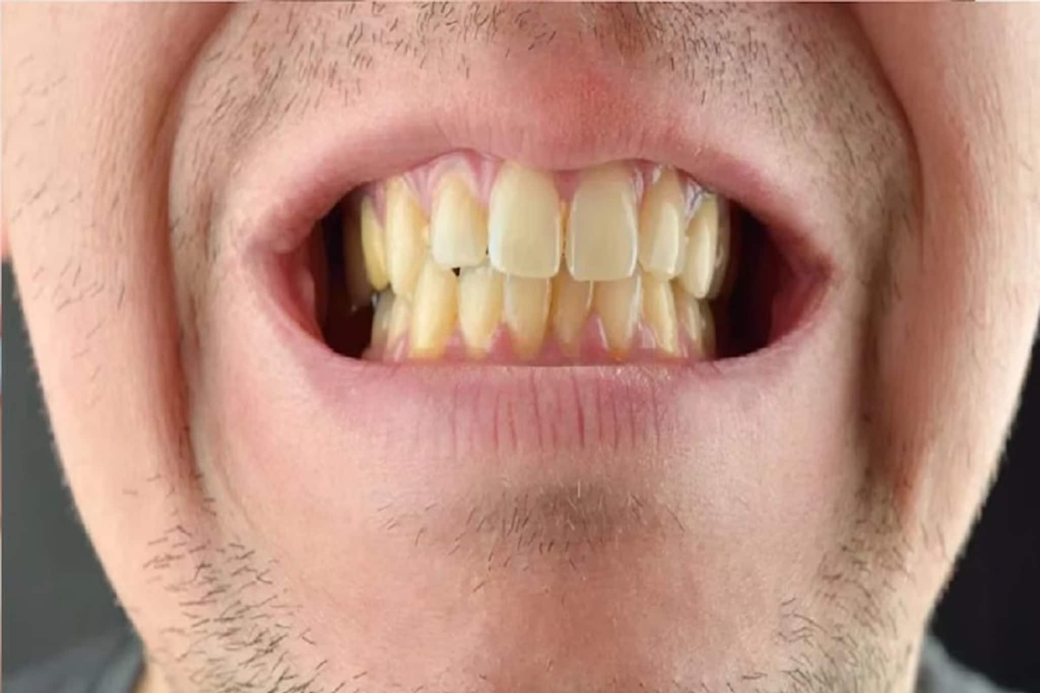 হাসলেই সামনে চলে আসে হলুদ দাঁত, লজ্জায় মুখ দেখাতে পারেন না! সস্তার ঘরোয়া টিপসেই মুক্তি...