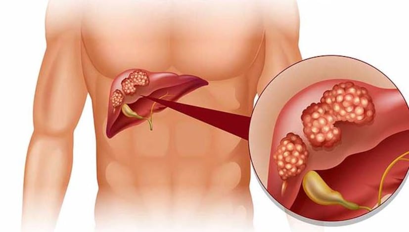যে ব্যক্তিরা খুব মোটা, তাদের NAFLD তে আক্রান্ত হওয়ার সম্ভাবনা বেশি। এছাড়াও টাইপ ২ ডায়াবেটিস, উচ্চ কোলেস্টেরল, উচ্চ রক্তচাপ এবং ইনসুলিন প্রতিরোধের সাথে যুক্ত অন্যান্য বিষয়গুলি তো আছেই।