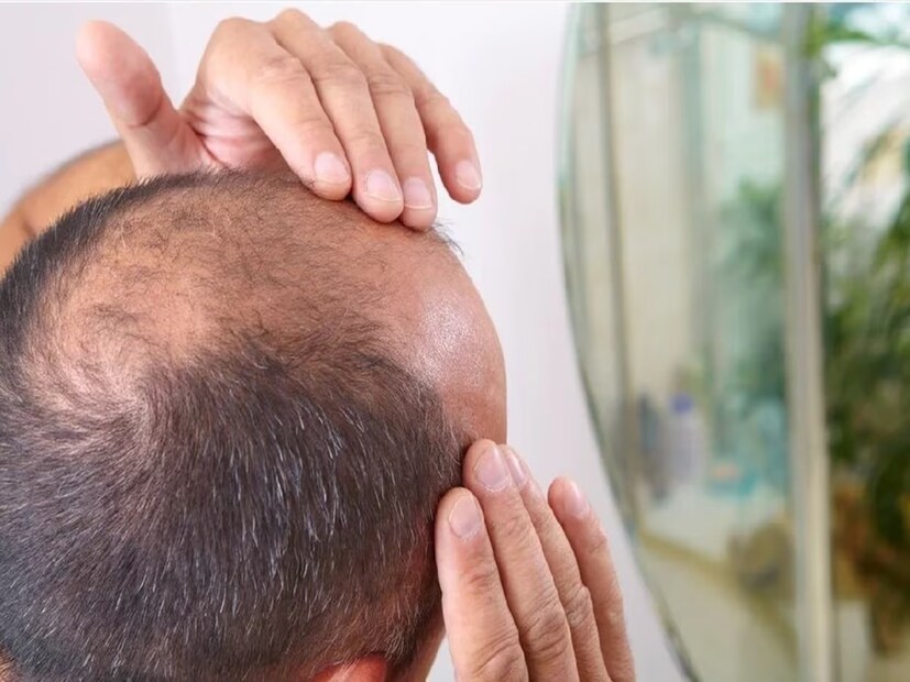 এছাড়া ওমেগা ফ্যাটি অ্যাসিড ক্যাপসুল বাজারে কিনতে পাওয়া যায়। সপ্তাহে ৩-৪ দিন তা ব্যবহার করলে ন্যাড়া মাথা ধীরে ধীরে ভরে উঠবে চুলে।