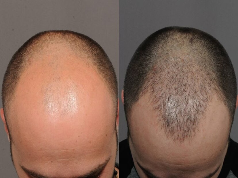 বিশিষ্ট চিকিৎসক কিংশুক দাশগুপ্ত জানান, টাক পড়ার সমস্যা থেকে মুক্তি পেতে চুলে ব্যবহার করুন অ্যালোভেরা। অ্যালোভেরার জেল চুলে ওঠা স্থানে নিয়মিত ব্যবহারে দ্রুত গজাবে চুল