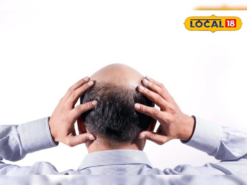 ক্যানসার, দুশ্চিন্তা, হৃদ্‌রোগ কিংবা আর্থ্রাইটিস, চর্মরোগ, খুশকি, ঘাম, অ্যান্ড্রোজেনিক হরমোনের কারণে অনেকের মাথায় টাক পড়ে। আবার দুশ্চিন্তা, অস্বাস্থ্যকর জীবনযাপন, বিভিন্ন ধরনের রাসায়নিক প্রসাধনী ব্যবহার করার কারণেও কিন্তু চুল পড়ে নিয়মিত। তবে এই টাক পড়ার সমস্যা থেকে রেহাই মিলবেই ঘরোয়া কিছু টিপস মেনে চললেই। 