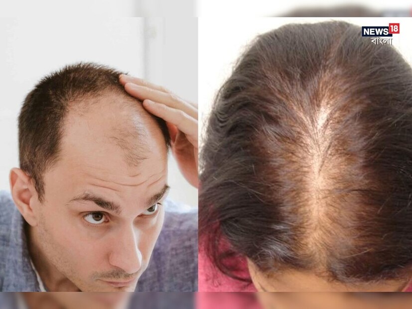 এছাড়া নারকেল তেলের সঙ্গে লেবুর রস মিশিয়ে একটি মিশ্রণ বানিয়ে নিন। শ্যাম্পু করার আগে এই মিশ্রণটি মাথায় মাখুন। তার কিছুক্ষণ তা রেখে দিন। তার শ্যাম্পু করে ধুয়ে নিন। ধৈর্য ধরে দীর্ঘদিন তা ব্যবহার করেন তাতে অপ্রত্যাশিত ফল পেতে পারেন।এইভাবে নিয়মিত মাথায় এই উপকরণ গুলি মালিশ করলে টাক মাথায় চুল গজাতে বেশি দেরি হবে না। (তথ্য-পিয়া গুপ্তা)