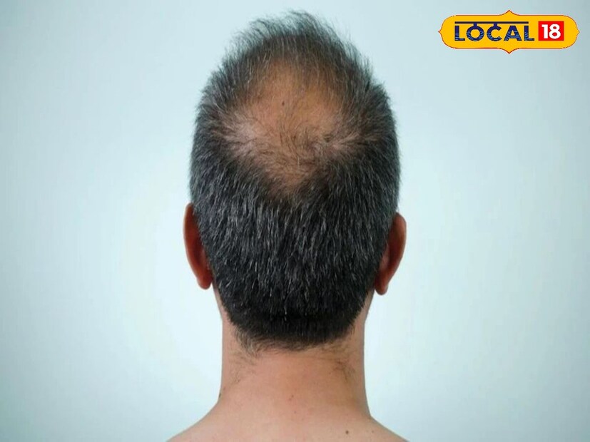 উত্তর দিনাজপুর: অল্প বয়সেই এখন বহু পুরুষের মাথায় চুল পড়ে গিয়ে টাক হতে দেখা যায়।বেশির ভাগ ক্ষেত্রেই জিনগত কারণে ছেলেদের চুল পড়ে। পরিবারে কারও চুলপড়ার ইতিহাস থাকলে পুরুষেরা বয়সের সঙ্গে সঙ্গে চুল পড়ার ঝুঁকিতে থাকেন। আবার অনেক সময় থাইরয়েডের সমস্যা, স্ক্যাল্প বা ত্বকের রোগ কিংবা চুল টেনে তোলার বদভ্যাস বা ট্রাইকোটিলোম্যানিয়া হলেও চুল পড়ে যায়। 