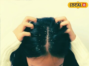 মাথায় দলা দলা খুশকি ভরে যাচ্ছে? ভরসা রাখুন এই 'একটি' জিনিসে! জানুন ডাক্তারের পরামর্শ মাথায় দলা দলা খুশকি ভরে যাচ্ছে? ভরসা রাখুন এই 'একটি' জিনিসে! জানুন ডাক্তারের পরামর্শ