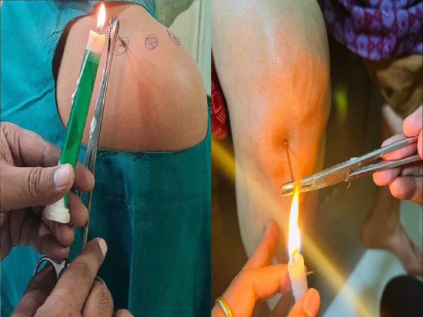 *স্বর্ণশালাকা বা পঞ্চশলাকার সাহায্যে এই সমস্ত রোগের চিকিৎসা মিলছে অগ্নিকর্ম পদ্ধতিতে। এটি ভারতের প্রাচীন চিকিৎসা পদ্ধতি তবে তেমন প্রচলন নেই। ধীরে ধীরে এই চিকিৎসা পদ্ধতির প্রচলন ব্যাপক হারে বৃদ্ধি পাচ্ছে। কারণ রোগীরা এই পদ্ধতিতে চিকিৎসা করে দ্রুত সুস্থ হয়ে উঠছেন। সংগৃহীত ছবি। 