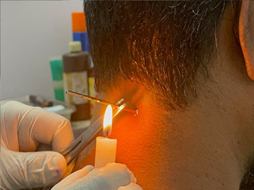 *ছোটখাটো অপারেশন বাদ দিয়ে একশো শতাংশ নির্ভরযোগ্য আয়ুর্বেদিক ডাক্তারদের কাছে। জানা যাচ্ছে, দীর্ঘদিনের ব্যথা পুরনো ব্যথা, পায়ে বা কোমরে ব্যথার জন্য চিকিৎসা করেও কোনও সুরাহা মিলছে না অথবা আপনার চোখের সামনে ছোট্ট আঁচিল সেই আঁচিল নিয়ে আপনার চোখ খুলতে অসুবিধার সম্মুখীন হচ্ছে অপারেশন ছাড়াই আপনার সেটা চলে যাবে আপনার চোখের সামনে থেকে। সংগৃহীত ছবি। 