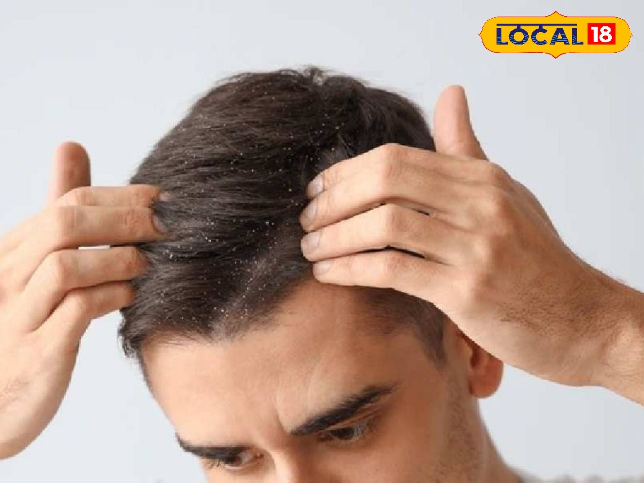 শীতকাল এলেই খুসকির সমস্যা! ঘরোয়া উপায়ে পাকাপাকি ভাবে দূর হবে খুসকি! জানুন