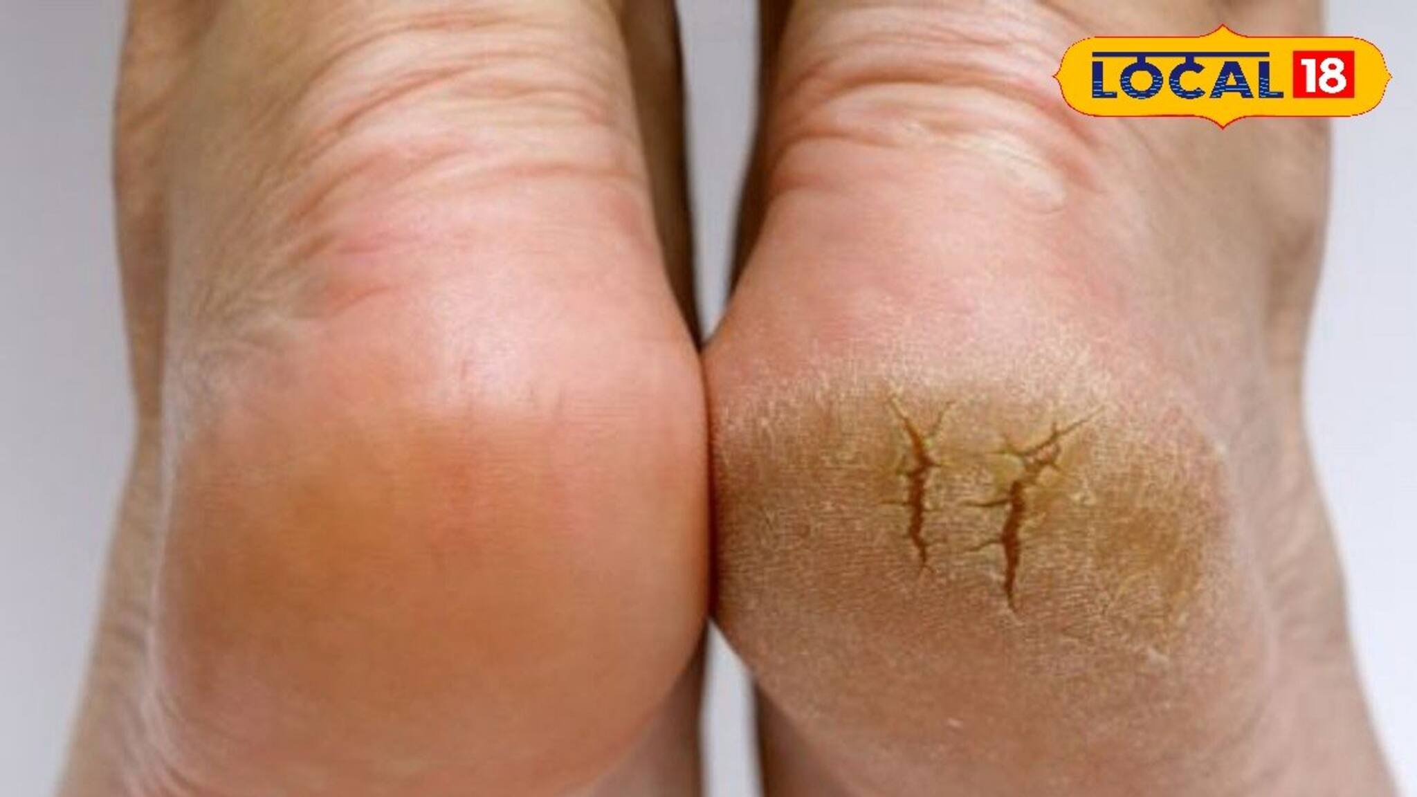 ফাটা গোড়ালির সমস্যা? এই নিয়ম মানলে একরাতে হবে উধাও! রইল সহজ ঘরোয়া সমাধান