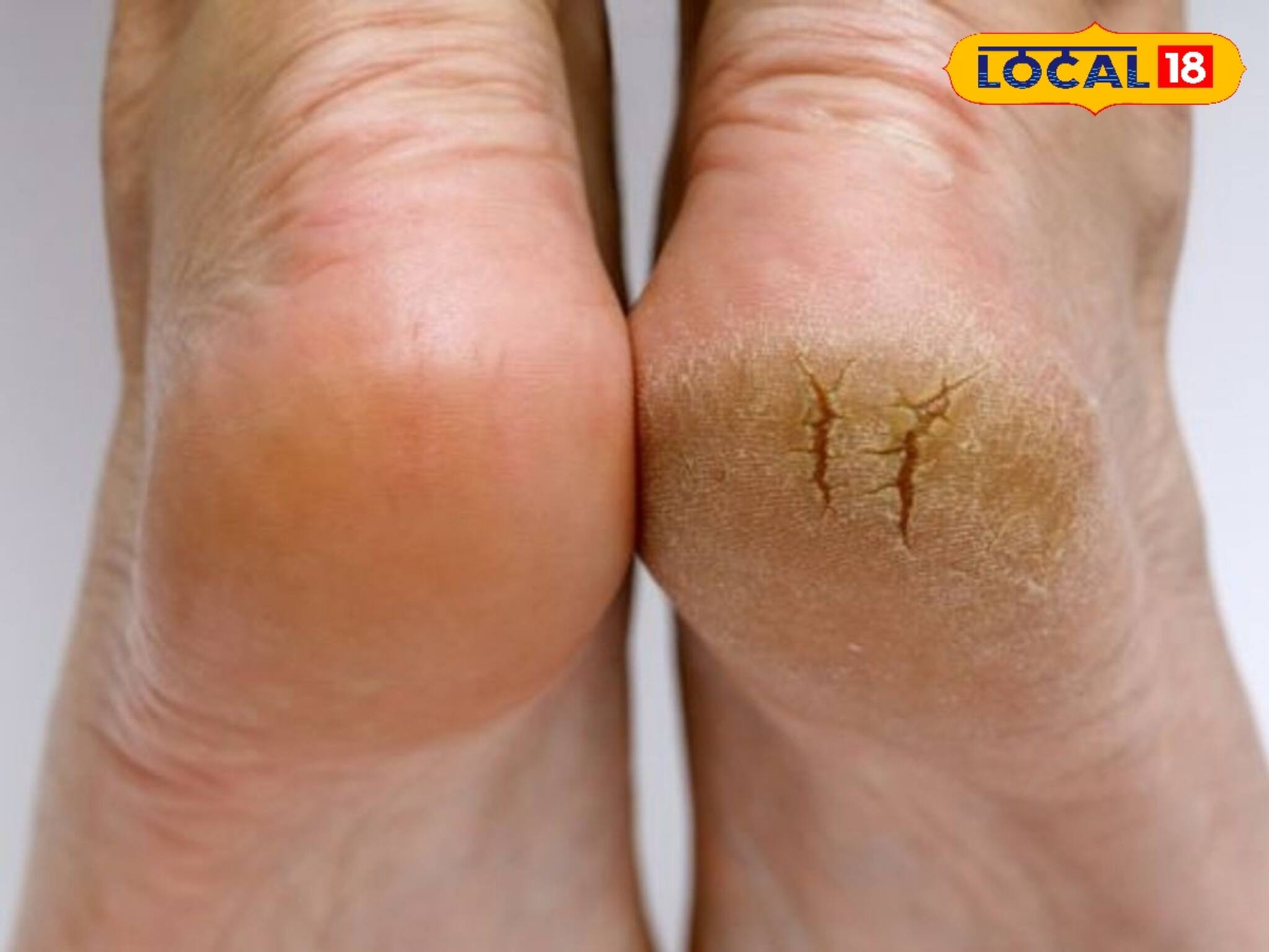 ফাটা গোড়ালির সমস্যা? এই নিয়ম মানলে একরাতে হবে উধাও! রইল সহজ ঘরোয়া সমাধান