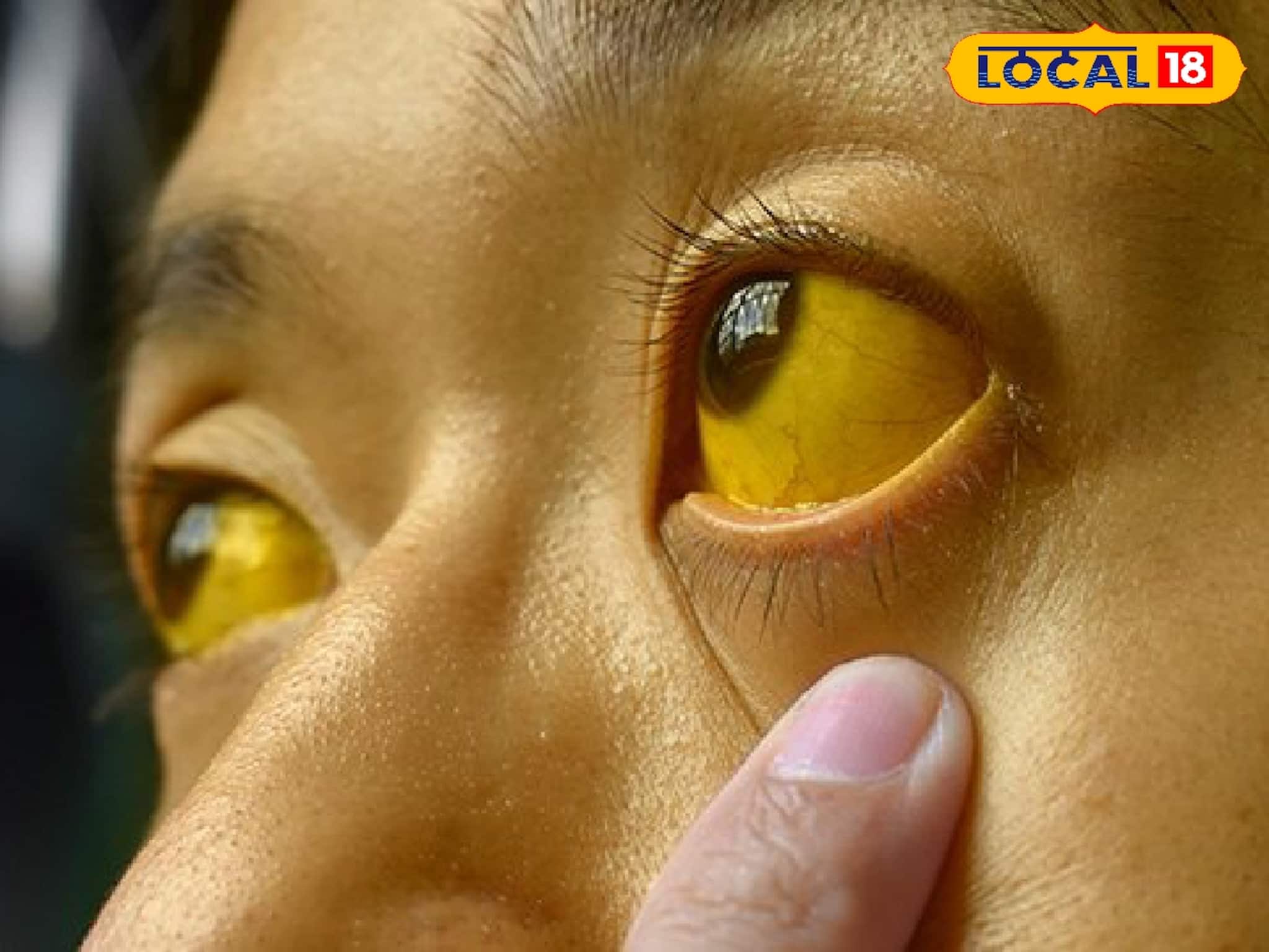 জন্ডিস-কে অবহেলা নয়, শুরুতেই সতর্ক হন, সহজ কিছু উপায়ে মোকাবিলা করুন মারণ রোগের