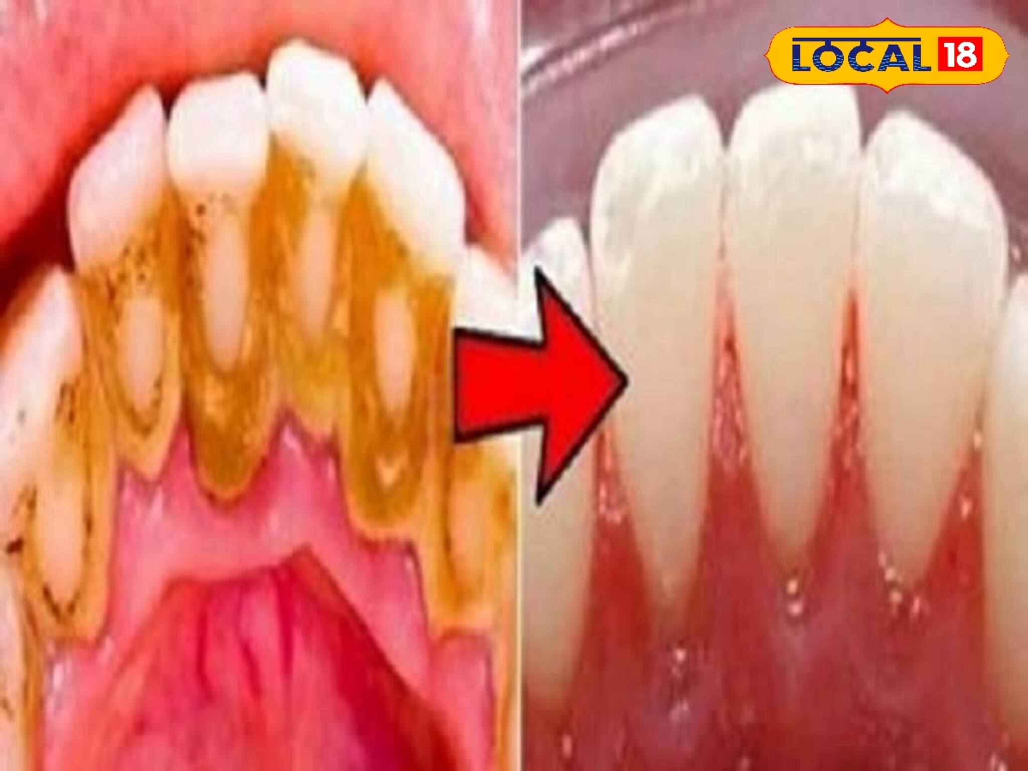 হলদেটে চর পড়া দাঁত?দামি পেস্ট না,ঘরোয়া ৫টোটকায় বাড়বে কনফিডেন্স,পাবেন ঝকঝকে সাদা দাঁত