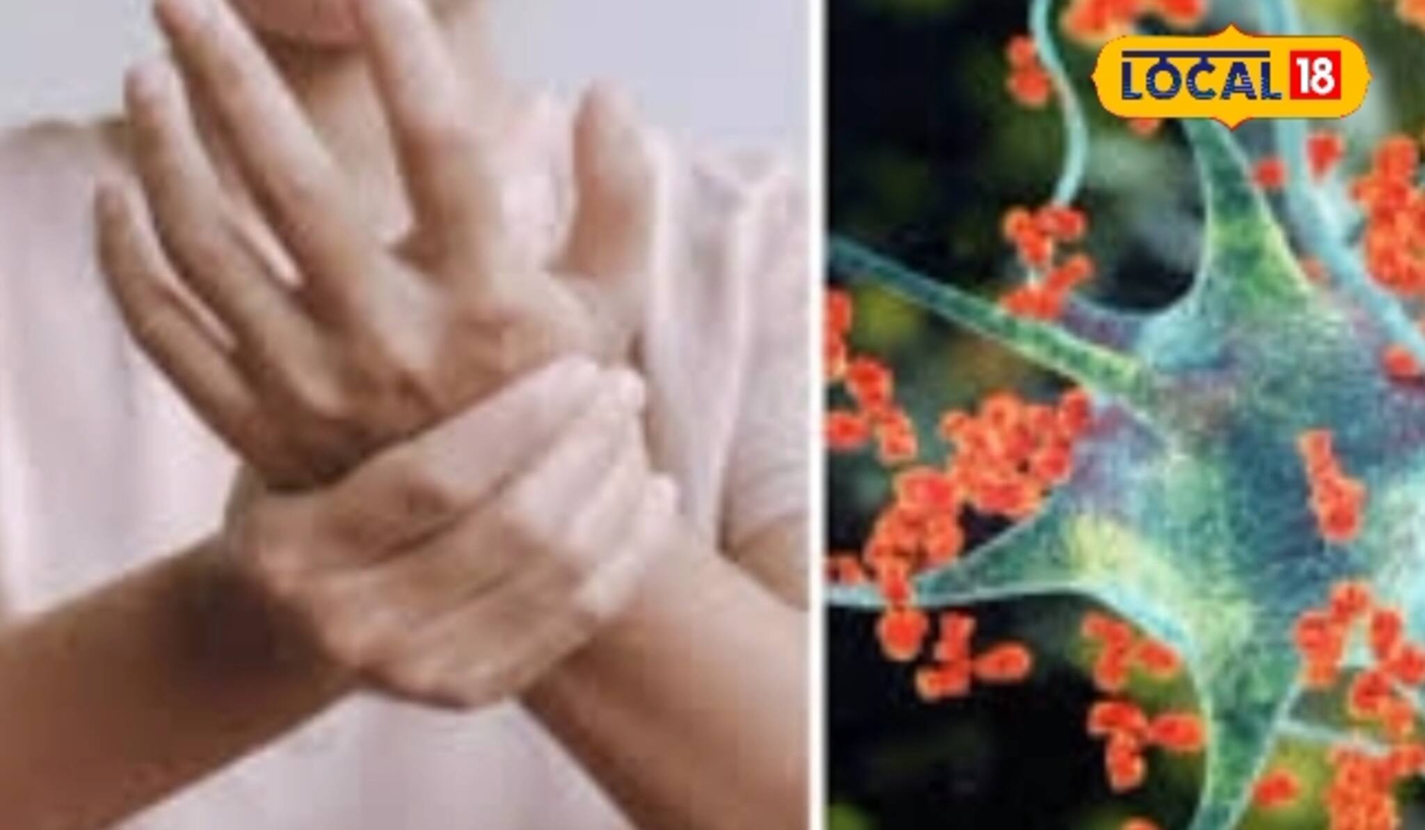 হাত ঝিনঝিন-পা অবশ?করোনা পরবর্তী নতুন আতঙ্ক গিলেন ব্যারি সিন্ড্রোম (GBS)!কীভাবে আটকাবেন?