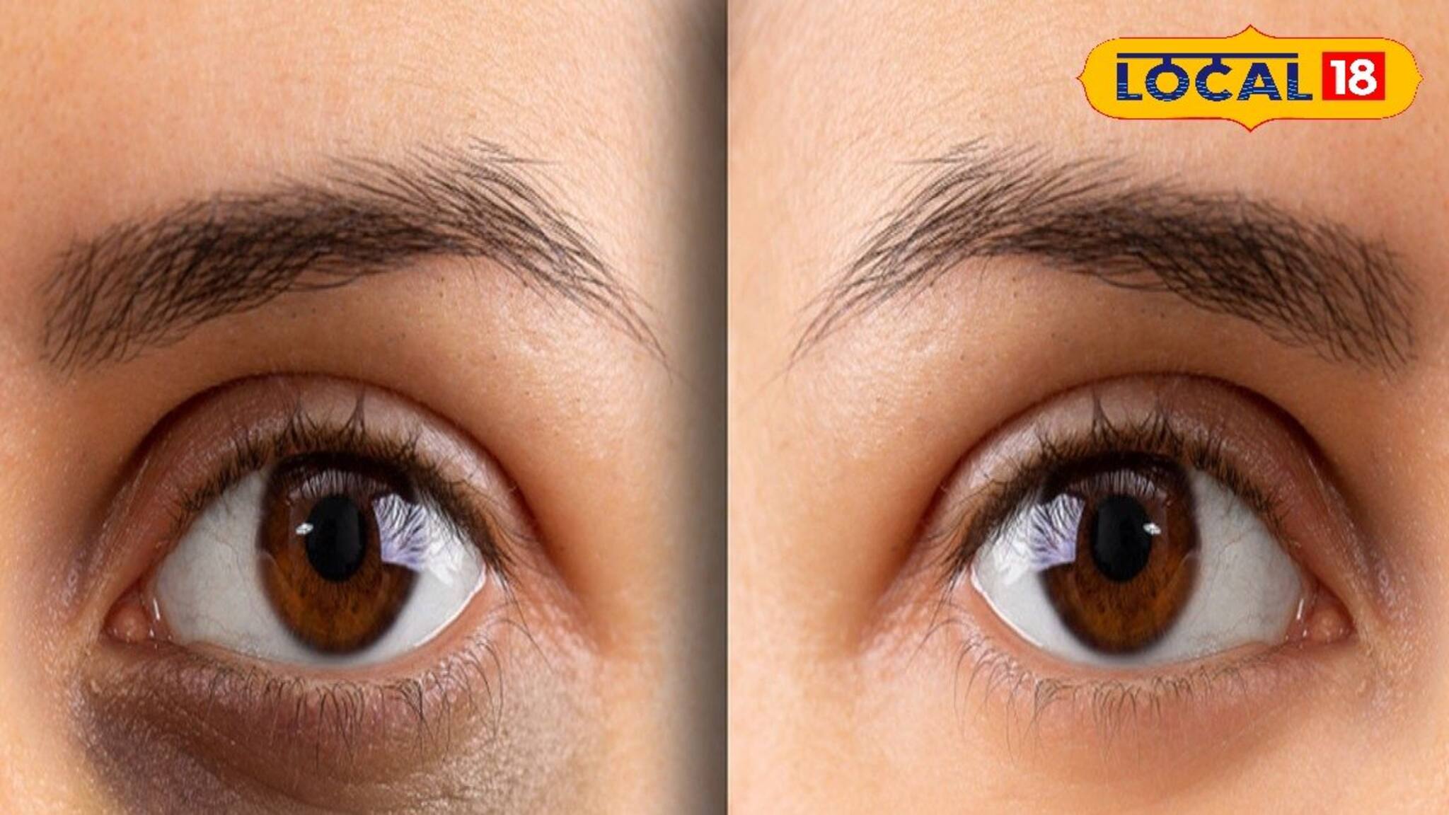 চোখের নিচের কালো ডার্ক সার্কল দূর হবে সাতদিনে! জানুন ঘরোয়া টোটকার ম্যাজিক