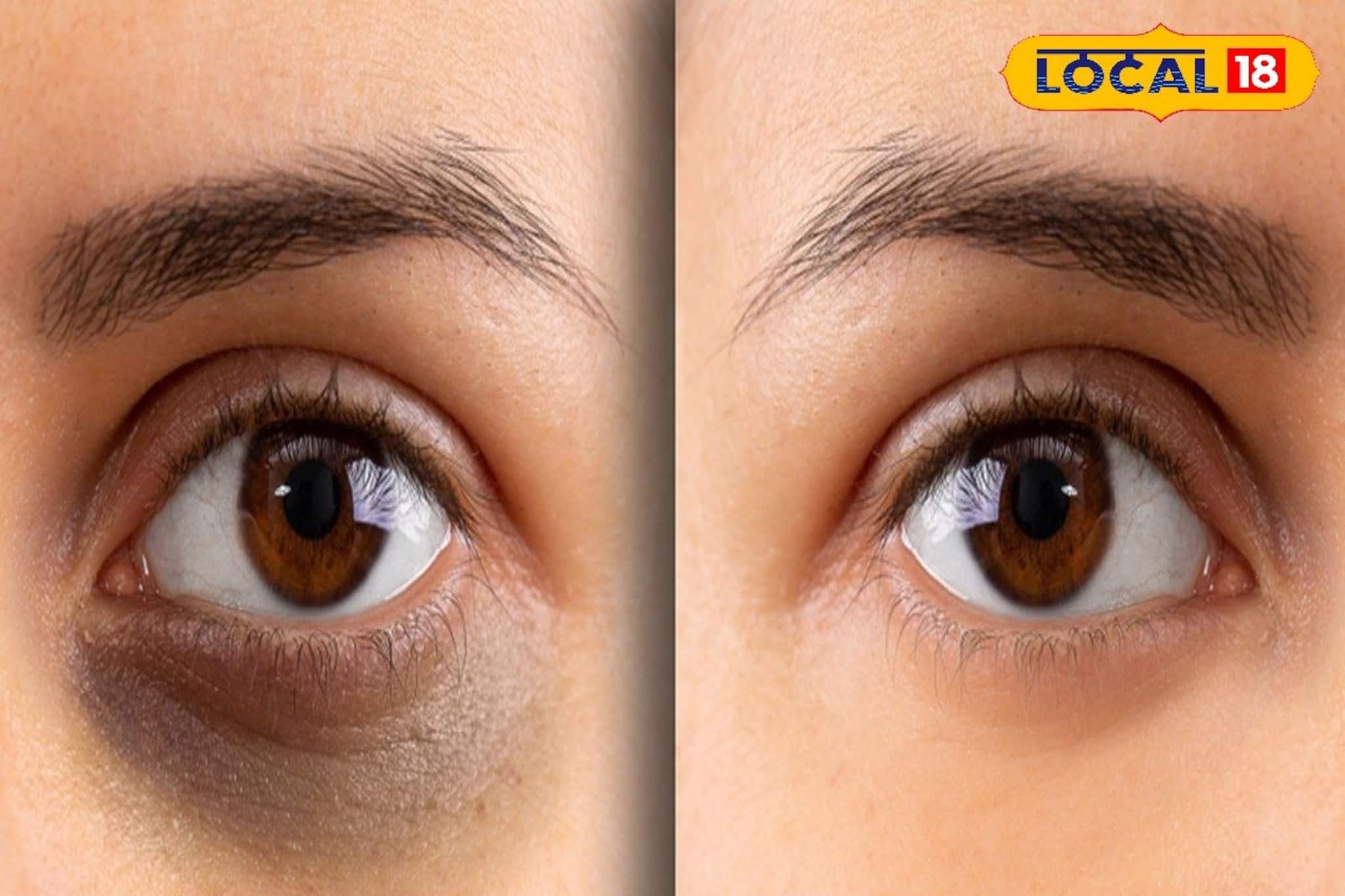 চোখের নিচের কালো ডার্ক সার্কল দূর হবে সাতদিনে! জানুন ঘরোয়া টোটকার ম্যাজিক