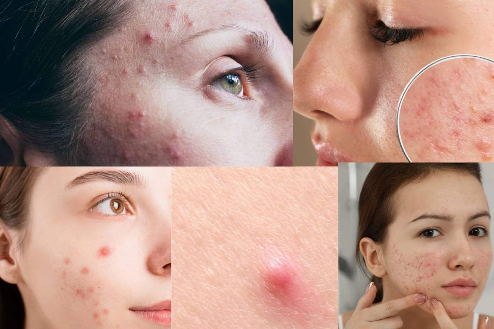 শরীরে এই ভিটামিনের অভাবে মুখ ভরে যাবে দাগে! ডায়েটে এই খাবারগুলো রাখুন, ঝকঝক করবে ত্বক...