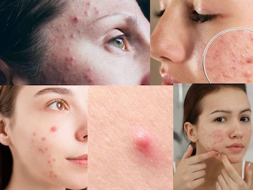 কোন ভিটামিনের অভাবে ব্রণর দাপটে ক্ষত বিক্ষত মুখ? অ্যাকনে, পিম্পল কমাতে খান এগুলি কোন ভিটামিনের অভাবে ব্রণর দাপটে ক্ষত বিক্ষত মুখ? অ্যাকনে, পিম্পল কমাতে খান এগুলি