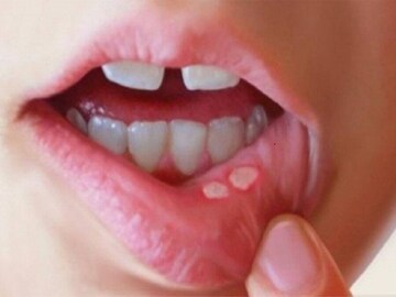 কোন ভিটামিনের অভাবে মাউথ আলসার হয়? এর জ্বালা থেকে মুক্তি পেতে কী খাবেন? জানুন