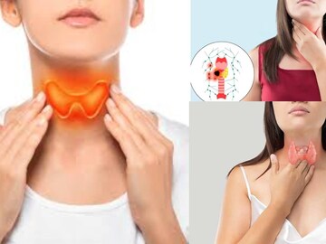 কোন ভিটামিনের অভাবে থাইরয়েড-জটিলতা হয়? জানুন থাইরয়েড সমস্যা রোধে কী খাবেন কোন ভিটামিনের অভাবে থাইরয়েড-জটিলতা হয়? জানুন থাইরয়েড সমস্যা রোধে কী খাবেন