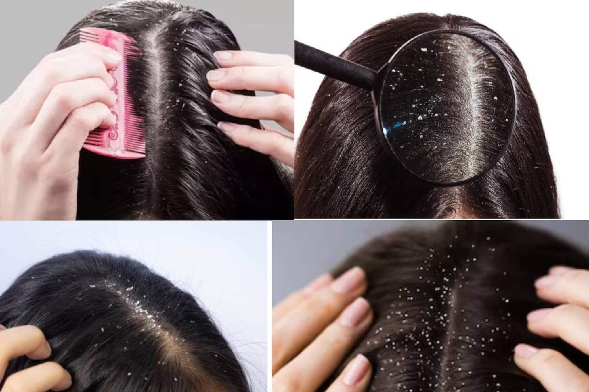 কোন ভিটামিনের অভাবে চুলে খুশকি হয়? কী কী খেলে শীতে খুশকি হবে না, জানুন