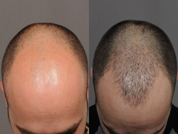 টাক মাথায় গজাবে চুল! হু-হু করে হবে গ্রোথ! কসমেটিক্স নয়, ভরসা রাখুন এই ঘরোয়া উপায়