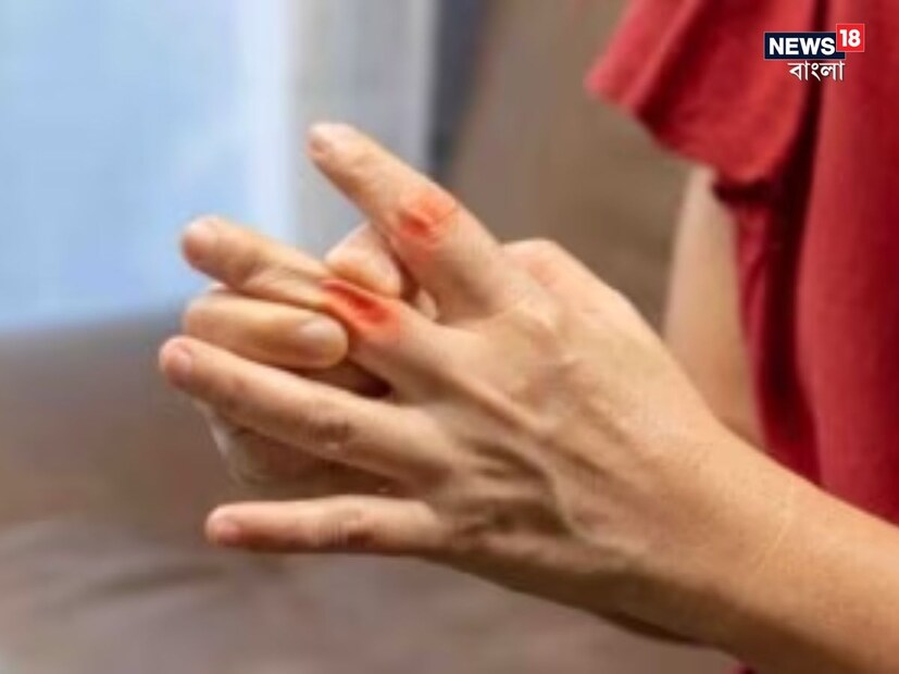 - যদি প্রস্রাব করার সময় ব্যথা বা জ্বালা অনুভব করেন তবে এটি উচ্চ ইউরিক অ্যাসিডের মাত্রার লক্ষণ হতে পারে। এটি মূত্রনালীর সংক্রমণ বা কিডনিতে পাথরের কারণেও হয়।