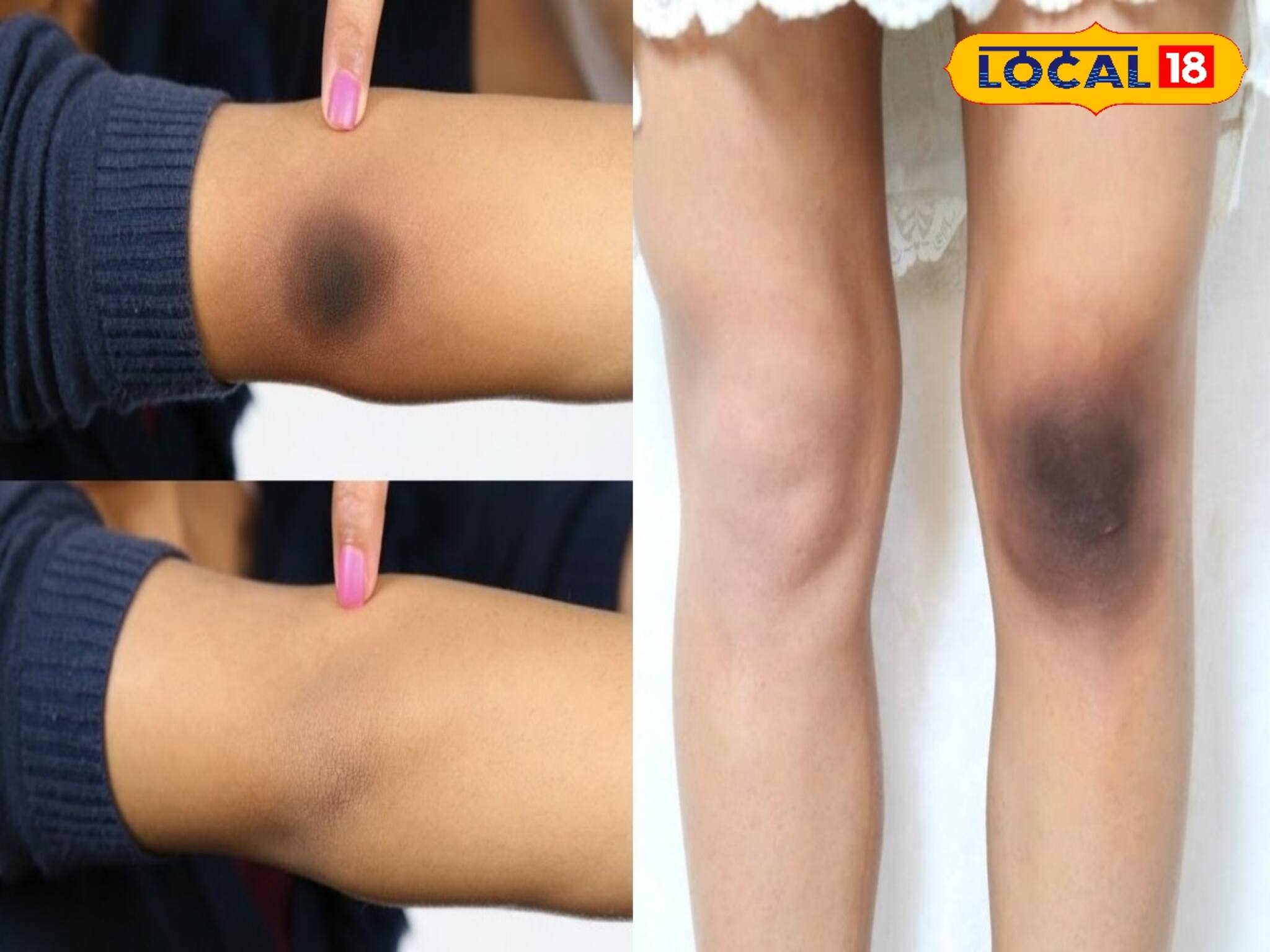 হাঁটু-কনুইয়ে কালো দাগ? ছুটতে হবে না পার্লারে, ঘরোয়া টোটকাতেই হতে পারে সুরাহা