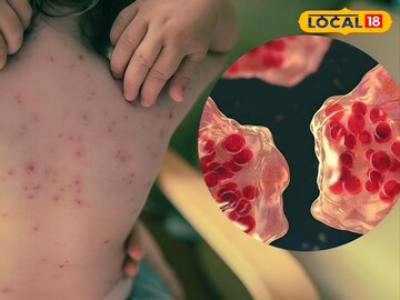 Health Tips: মরশুম পরিবর্তনেই হামের আতঙ্ক! কী ভাবে বাঁচবেন এই রোগ থেকে! জেনে নিন চিকিৎসকের পরার্মশ