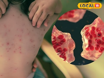 Health Tips: মরশুম পরিবর্তনেই হামের আতঙ্ক! কী ভাবে বাঁচবেন এই রোগ থেকে! জেনে নিন চিকিৎসকের পরার্মশ Health Tips: মরশুম পরিবর্তনেই হামের আতঙ্ক! কী ভাবে বাঁচবেন এই রোগ থেকে! জেনে নিন চিকিৎসকের পরার্মশ