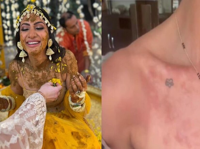 নিজের ইনস্টাগ্রাম স্টোরি একটি পোস্ট শেয়ার করে নীলম বলেন যে, পৃথিবীতে কী রয়েছে? আমার মনে হয়, রোদে হলুদ বাটা বা হলদি পেস্টের প্রতিক্রিয়া এটা। যদিও আমি অনুষ্ঠানের দিন কয়েক আগেই প্যাচ টেস্ট করেছিলাম। আর সব কিছু তখন তো ঠিকই ছিল। 