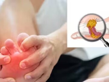 এসব চেনা খাবারেই চড়চড়িয়ে বাড়ে ইউরিক অ্যাসিড! গাঁটের ব্যথা ভ্যানিশ করতে কী কী খাবেন না?