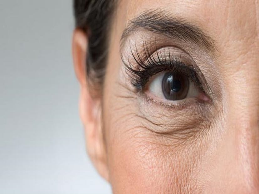 বয়স বাড়ার সঙ্গে সঙ্গে ত্বকে বলিরেখা পড়া বা ত্বক ঝুলে পড়া খুব স্বাভাবিক। বয়স বাড়লে কোষের কার্যক্ষমতা কমতে শুরু করে। ত্বক পাতলা হয়ে যায়। ত্বকের আর্দ্রতা ও স্থিতিস্থাপকতা হ্রাস পায়। ত্বক ইলাস্টিসিটি হারায়। ফলে, ত্বকে বলিরেখা, ভাঁজ বা বিভিন্ন দাগ দেখা দেয়। কিন্তু অনেক ক্ষেত্রেই দেখা যায়, অল্প বয়সেই ত্বকে বলিরেখা বা ত্বক ঝুলে পড়েছে।  বয়স বাড়ার সঙ্গে সঙ্গে ত্বকে বলিরেখা পড়া বা ত্বক ঝুলে পড়া খুব স্বাভাবিক। বয়স বাড়লে কোষের কার্যক্ষমতা কমতে শুরু করে। ত্বক পাতলা হয়ে যায়। ত্বকের আর্দ্রতা ও স্থিতিস্থাপকতা হ্রাস পায়। ত্বক ইলাস্টিসিটি হারায়। ফলে, ত্বকে বলিরেখা, ভাঁজ বা বিভিন্ন দাগ দেখা দেয়। কিন্তু অনেক ক্ষেত্রেই দেখা যায়, অল্প বয়সেই ত্বকে বলিরেখা বা ত্বক ঝুলে পড়েছে।