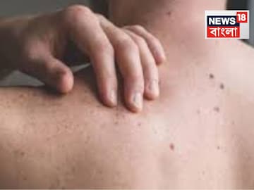 ত্বকে এই সমস্যাগুলি দেখা দিলে অবহেলা করবেন না! হাই কোলেস্টেরলের ছোবলে 'ছবি' হতে পারেন... ত্বকে এই সমস্যাগুলি দেখা দিলে অবহেলা করবেন না! হাই কোলেস্টেরলের ছোবলে 'ছবি' হতে পারেন...