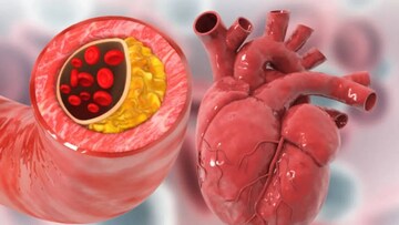 পালাবে খারাপ কোলেস্টেরল! গলবে প্লেকের আস্তরণ! ছুঁতেও পারবে না হার্ট অ্যাটাক! ৭ সহজ উপায় পালাবে খারাপ কোলেস্টেরল! গলবে প্লেকের আস্তরণ! ছুঁতেও পারবে না হার্ট অ্যাটাক! ৭ সহজ উপায়