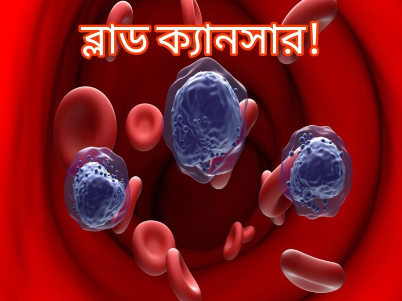 ব্লাড ক্যানসারের প্রাথমিক লক্ষণ: ক্যানসার একটি মারাত্মক রোগ। এই রোগের অনেক ধাপ রয়েছে। কিন্তু বিশেষজ্ঞ চিকিৎসকদের মতে প্রাথমিক পর্যায়ে ক্যানসারের চিকিৎসা করলে এই রোগ প্রতিরোধ করা সম্ভব। আসুন ডাক্তারের কাছ থেকে জেনে নিই ব্লাড ক্যানসারের প্রাথমিক লক্ষণগুলি ঠিক কী কী?