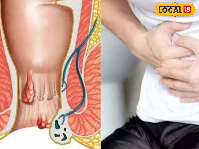 *এই রোগ এড়াতে সবচেয়ে ভাল উপায় হল ভাজা খাবার এবং জাঙ্ক ফুড এড়িয়ে চলা। সঠিক পরিমাণে জল পান করা উচিত এবং শারীরিকভাবে সক্রিয় থাকা উচিত। তিনি বলেন, পাইলস একটি পেটের রোগ, যা ভুলভাল খাবার জন্য বাড়ে।