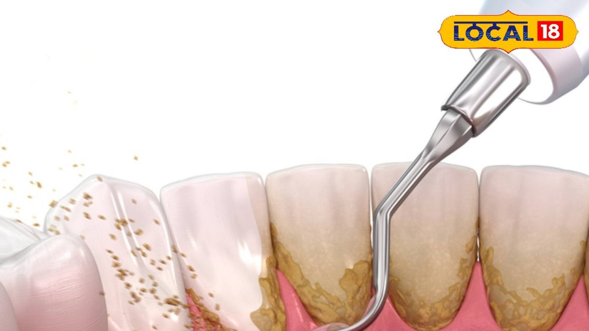 স্কেলিংয়ে কী ক্ষতি হয় দাঁতের? কত দিন পরপরই বা করা উচিত? জানুন চিকিৎসকের মত