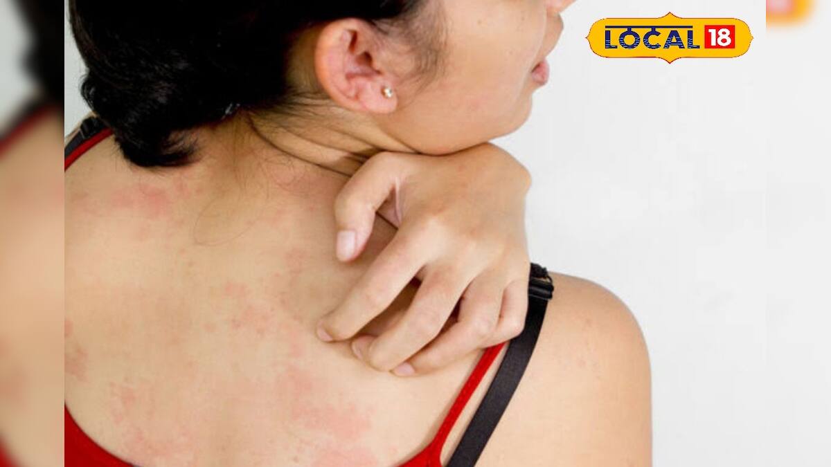 Heat Rash: গরমে ঘামাচির জ্বালায় জ্বলছেন? বাজারচলতি ক্রিম-পাউডার নয় ...