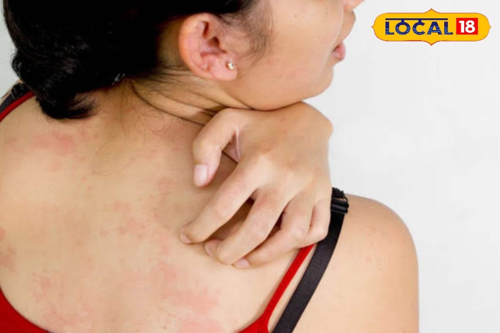 তীব্র দাবদাহে ঘামাচি নির্মূল করুন সহজ উপায়ে