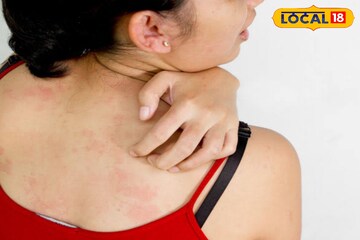 তীব্র দাবদাহে ঘামাচি নির্মূল করুন সহজ উপায়ে