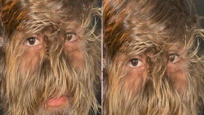 তাঁর এই অবস্থার কারণ হল একটি বিরল রোগ। যা হাইপারট্রিকোসিস নামে পরিচিত। শুধু তা-ই নয়, এই বিরল রোগটিকে ‘ওয়েরউলফ সিন্ড্রোম’ বলেও ডাকা হয়। এই অবস্থার কারণে শরীরের বিভিন্ন অংশে অতিরিক্ত বড় বড় লোম গজাতে থাকে। জিডব্লিউআর ওয়েবসাইটে বলা হয়েছে যে, সারা বিশ্বে শুধুমাত্র হাইপারট্রিকোসিসের ৫০টি ঘটনা নথিবদ্ধ করা হয়েছে। তাঁর এই অবস্থার কারণ হল একটি বিরল রোগ। যা হাইপারট্রিকোসিস নামে পরিচিত। শুধু তা-ই নয়, এই বিরল রোগটিকে ‘ওয়েরউলফ সিন্ড্রোম’ বলেও ডাকা হয়। এই অবস্থার কারণে শরীরের বিভিন্ন অংশে অতিরিক্ত বড় বড় লোম গজাতে থাকে। জিডব্লিউআর ওয়েবসাইটে বলা হয়েছে যে, সারা বিশ্বে শুধুমাত্র হাইপারট্রিকোসিসের ৫০টি ঘটনা নথিবদ্ধ করা হয়েছে।